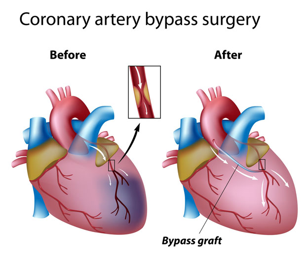 C A B G Bypass Surgery Dr Amit Chaudhari